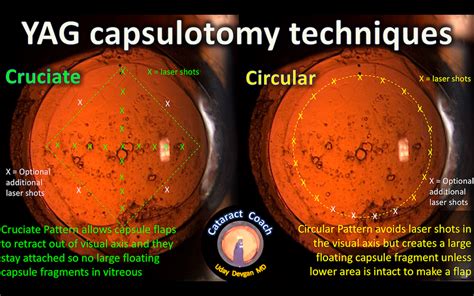 YAG Laser Capsulotomy Techniques – Cataract Coach