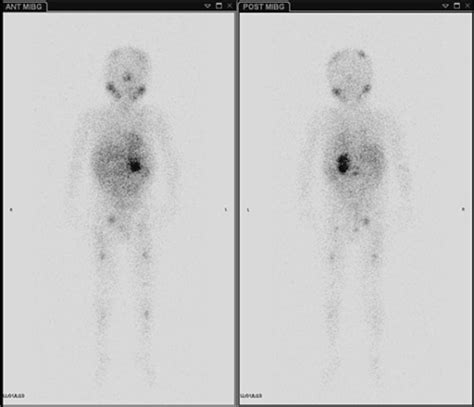 Today’s case is a whole body iodine-123 MIBG scan... | Teaching Rounds