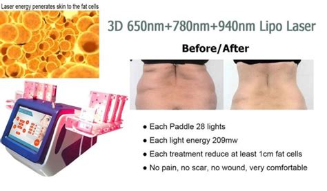 Why Choose Lipo Laser Machine For Body Slimming