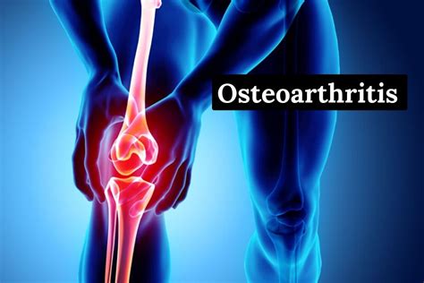 Osteoarthritis System Disorder Template