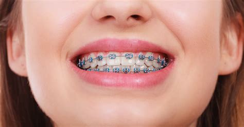 Teeth Braces in Brighton & Hove | Clear Braces | Splash Orthodontics