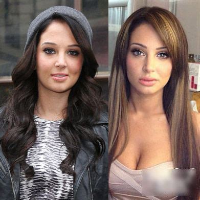 Tulisa Plastic Surgery Before and After Photos | Celebrity surgery, Hair implants, Plastic ...