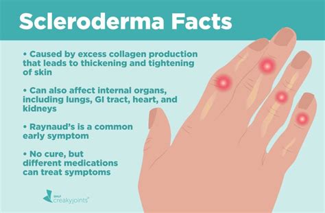 Systemic Scleroderma Hands