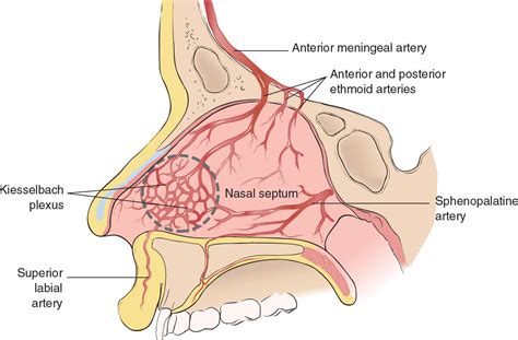 Epistaxis | Anesthesia Key