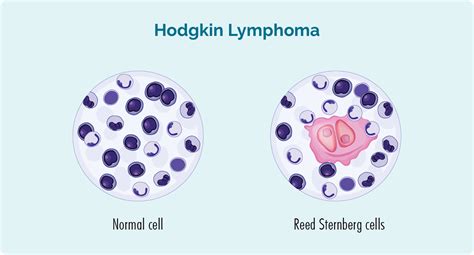 Non-Hodgkin Lymphoma (NHL) - Lymphoma Australia