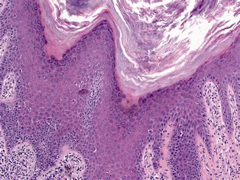 Oral Lichen Planus Histology