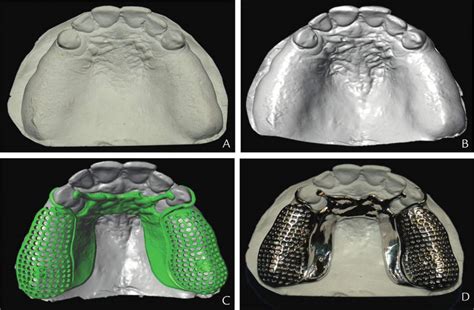 Clinical trial finds 3D printed dentures are preferred to conventional ...