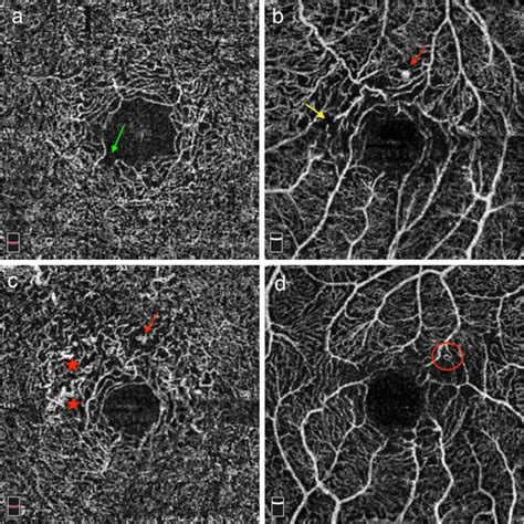 Optical coherence tomographic angiographic (OCTA) images (3 × 3 mm) of ...