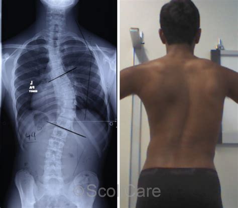 Reduction of a severe scoliosis using scoliosis specific rehabilitation