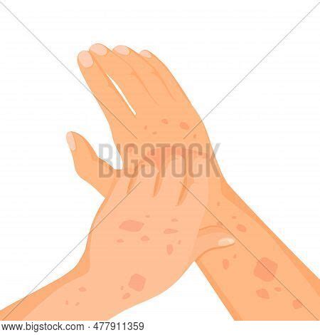 Rash Skin On Hand. Vector & Photo (Free Trial) | Bigstock