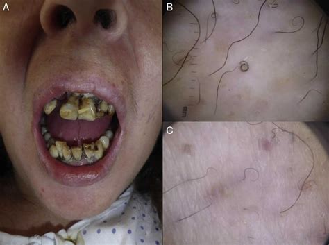 Vitamin C deficiency, scurvy, causes, symptoms, diagnosis & treatment