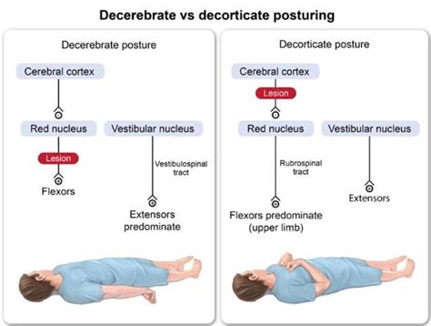 Decorticate vs Decerebrate posturing