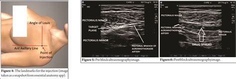 Peripheral nerve stimulator guided pectoralis (PEC-I) block: A novel approach to the chest wall ...