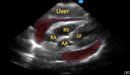 POCUS Spotlight: Subcostal Cardiac Ultrasound