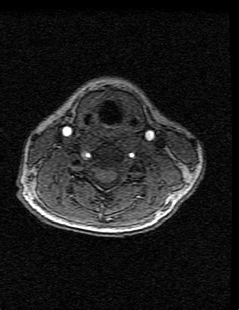 Vertebral artery dissection - wikidoc