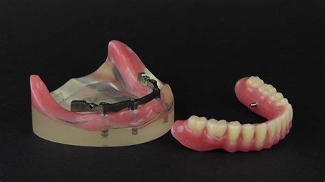 Benefits of PEEK prosthesis – PEEK Denture