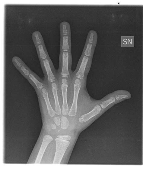 Gelastic Seizures: Bone age x-ray