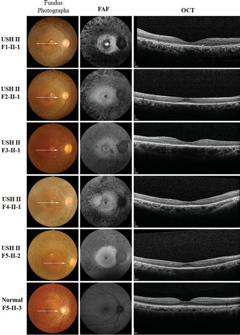 Fundus photography, FAF imaging, and foveal OCT scans of probands from... | Download Scientific ...