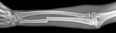 Broken Arm, X-ray Photograph by Du Cane Medical Imaging Ltd