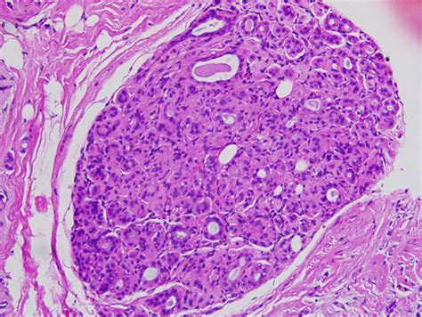 Carcinoma, Ductal