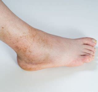 Swollen Ankles In Senior Citizens | Ankle Care in Roseville