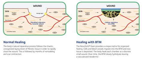 What is NovoSorb® BTM?