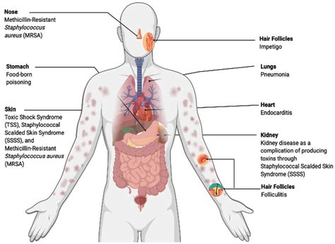 Infections caused by Staphylococcus aureus | Download Scientific Diagram