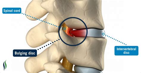 Lumbar Disc Bulge - Masnad Health Clinic