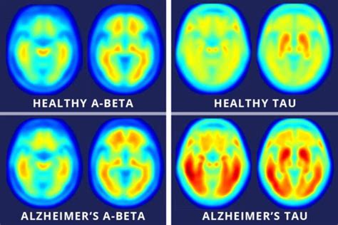 Brain Scans Further Link Alzheimer's Disease to Tau Proteins - Newsweek