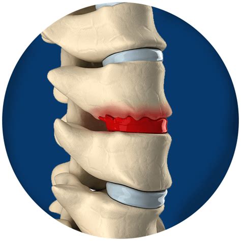 Bone Spurs | The Advanced Spine Center