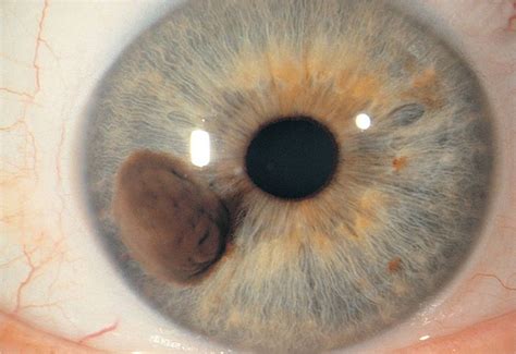 Pupil, Iris, and Lens Abnormalities - Visual Diagnosis and Treatment in Pediatrics, 3 Ed.