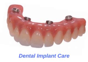 Caring For Dental Implants – Oceansight Dental & Implants