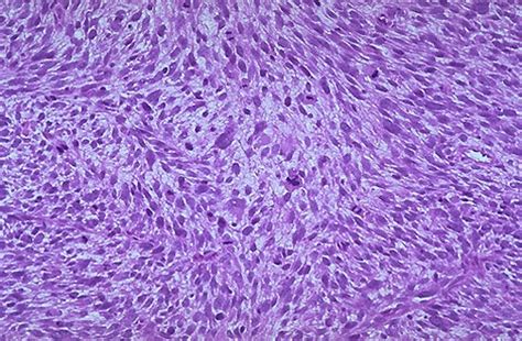 Pathology Outlines - Leiomyosarcoma