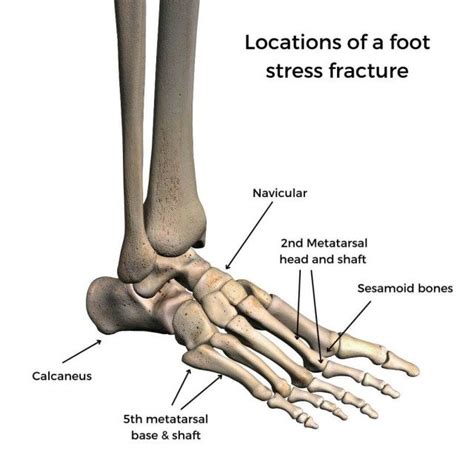 Stress Fracture: Causes, Symptoms & Treatment | The Feet People Podiatry