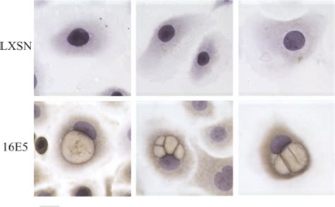 Koilocytotic cells. A: The HPV cytopathic effect (koilocytosis) is ...