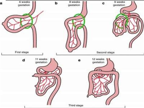 Midgut volvulus