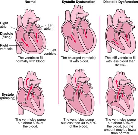 DIASTOLIC DYSFUNCTION - WeCare Germany