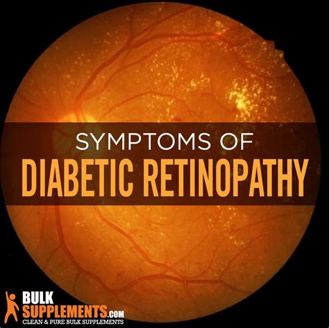 Diabetic Retinopathy: Causes, Symptoms & Treatment