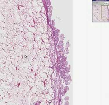 Histopathology Lung, pleura-- Mesothelioma - YouTube