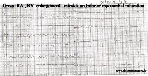 non infarct q waves | Dr.S.Venkatesan MD