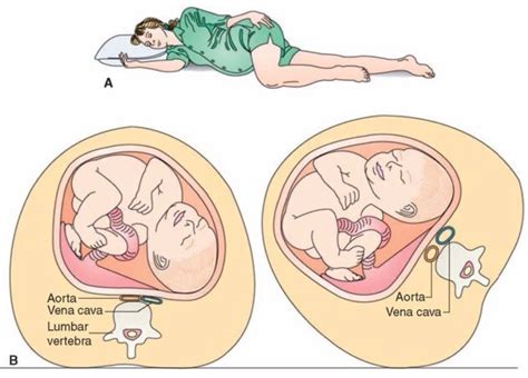 Vulvar Varicosities Treatment