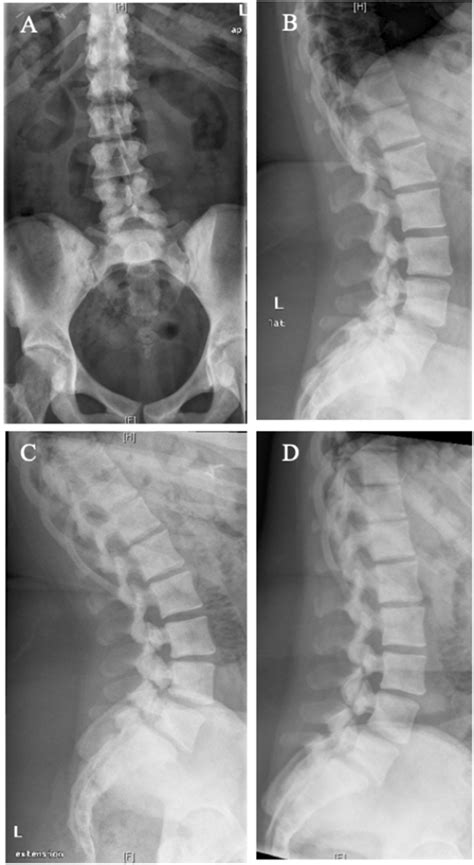 X-rays of lumbar spine showing sclerosis of the bones and spondylolyses ...