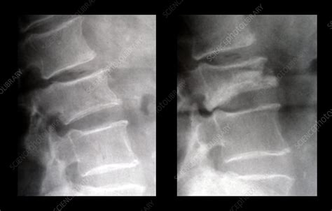 Lumbar Compression Fracture - Stock Image - M330/1636 - Science Photo ...