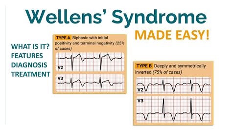 NOT-TO-MISS condition: Wellens' syndrome - YouTube