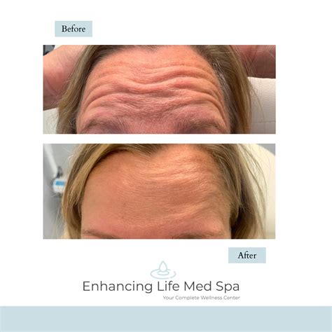 Botox – Enhancing Life Med Spa