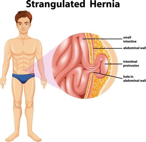 Oblique Pain: Muscle Strain Or Sports Hernia? Determine Your Injury In Seconds.