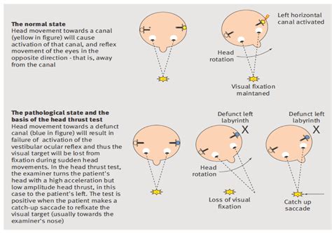 Head thrust test - Charlie's ED