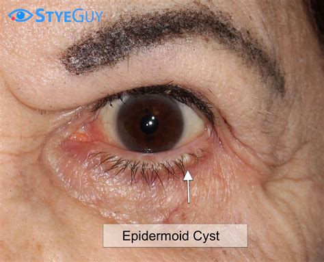 Epidermoid Cyst | StyeGuy