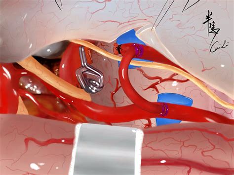 Illustrative case of s1 aneurysm treatment. Intraoperative picture (a ...