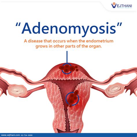 Adenomyosis - Vejthani Hospital